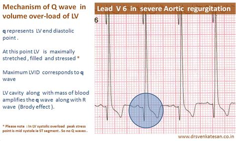 consider ischemia or lv overload|left ventricular overload.